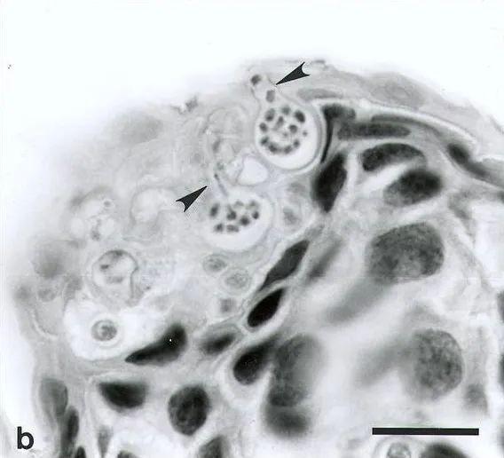 被壶菌感染的皮肤组织,孢子囊清晰可见